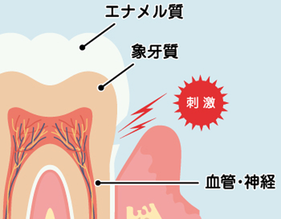 摂津市(千里丘)の歯医者、ひろ歯科の接着歯科技術