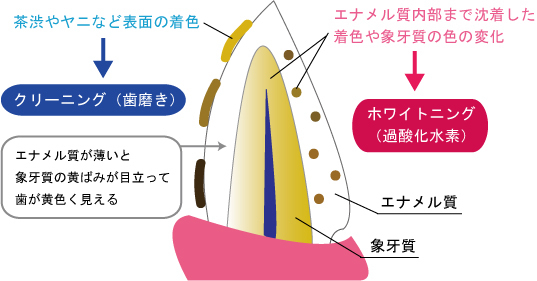 摂津市(千里丘)の歯医者、ひろ歯科のホワイトニング